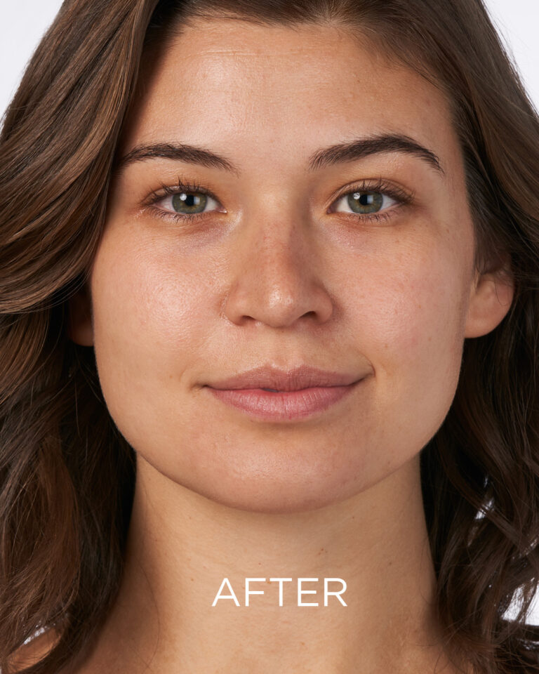 Kuva sosiaaliseen mediaan NEOSTRATA Mandelic Clarifying Hydragel (after)