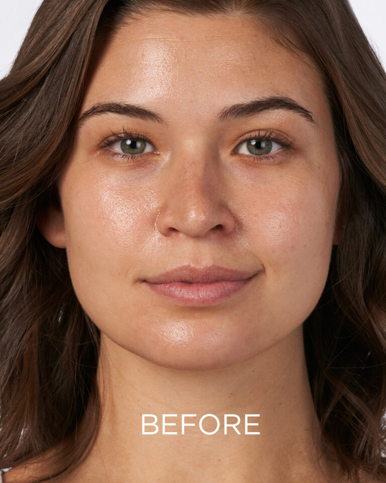 Kuva sosiaaliseen mediaan  NEOSTRATA Mandelic Clarifying Hydragel (before)