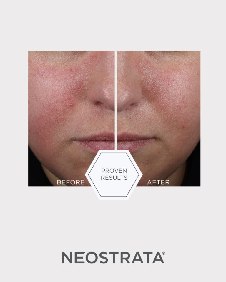 Kuva sosiaaliseen mediaan NEOSTRATA Mandelic Clarifying Hydragel 1