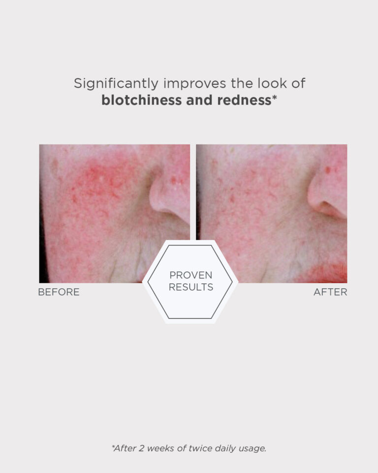 Kuva sosiaaliseen mediaan NEOSTRATA Redness Neutralizing Serum 5