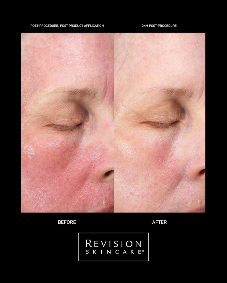 Kuva sosiaaliseen mediaan Revision Skincare CMT results
