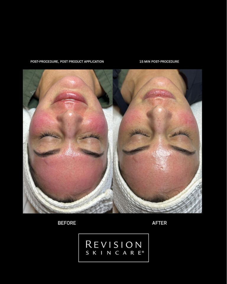 Kuva sosiaaliseen mediaan Revision Skincare CMT results